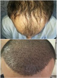 hair transplant