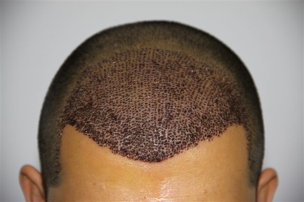 hair transplant