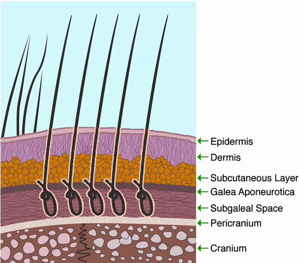 Biofibre hair transplant opinion