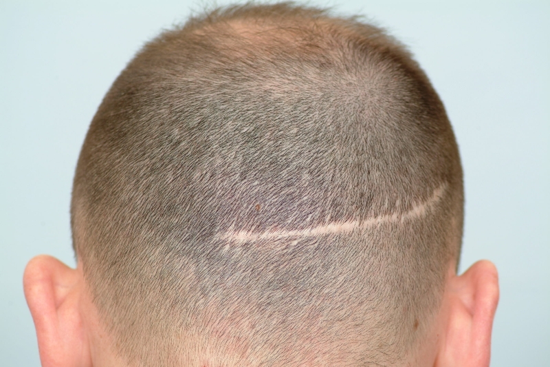 Hair transplant on scar