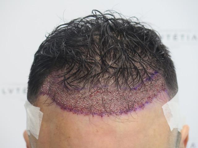 Greffe de cheveux dhi france